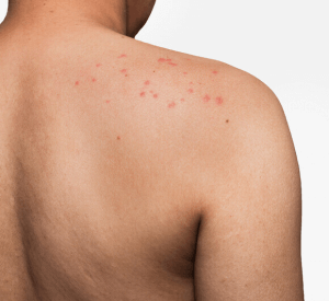 Skin rash